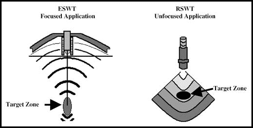 The Effectiveness Of Radial Extracorporeal Shock Wave Therapy In Patie