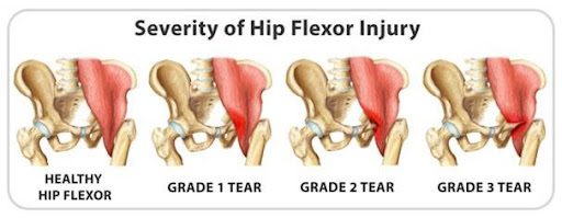 Figure 2. Severity of hip flexor strain https://gohockeynews.com/sports-medicine-hip-flexor-strain-a-long-term-problem-for-hockey-players/