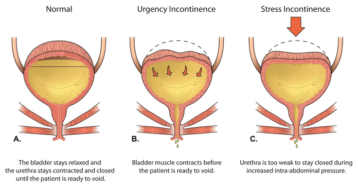Types of Incontinence